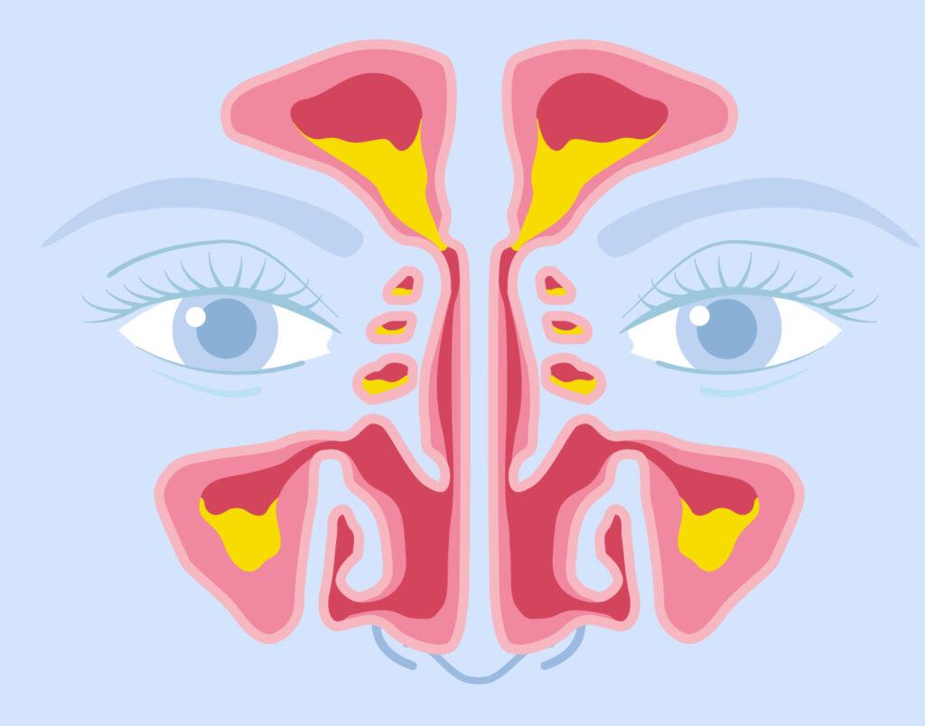 Sinusitis